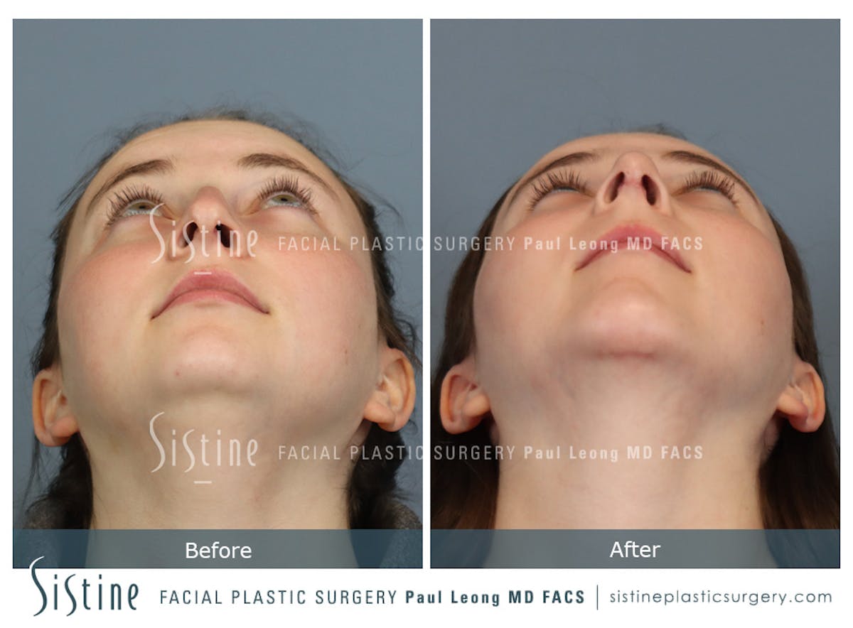 Chin Implant Before & After Gallery - Patient 116545 - Image 9