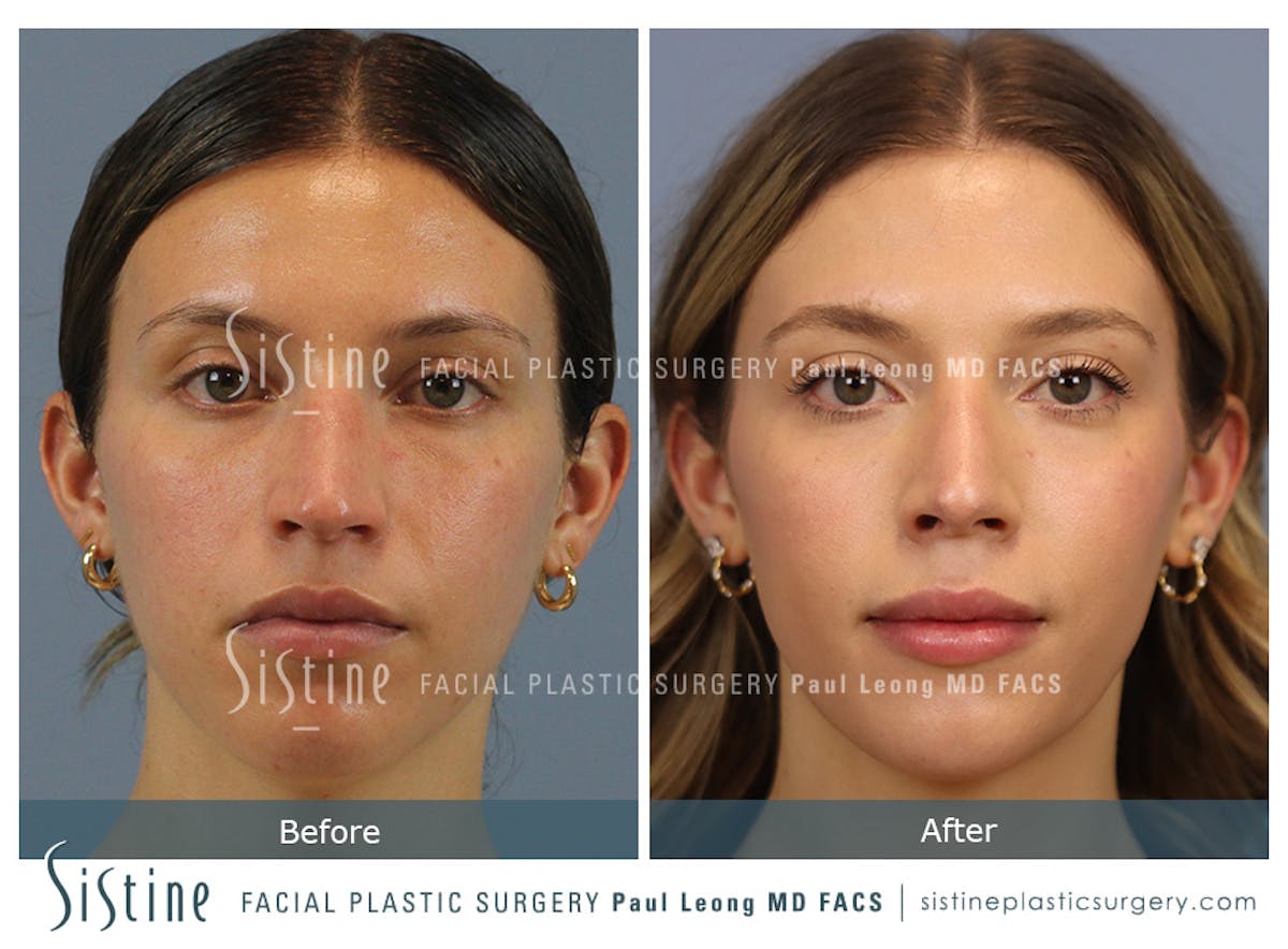 Rhinoplasty Before & After Gallery - Patient 238532 - Image 1