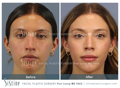 Rhinoplasty Before & After Gallery - Patient 238532 - Image 1
