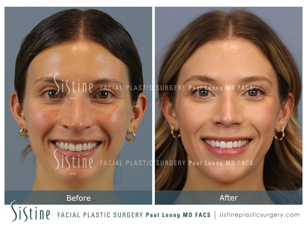 Rhinoplasty Before & After Gallery - Patient 238532 - Image 2