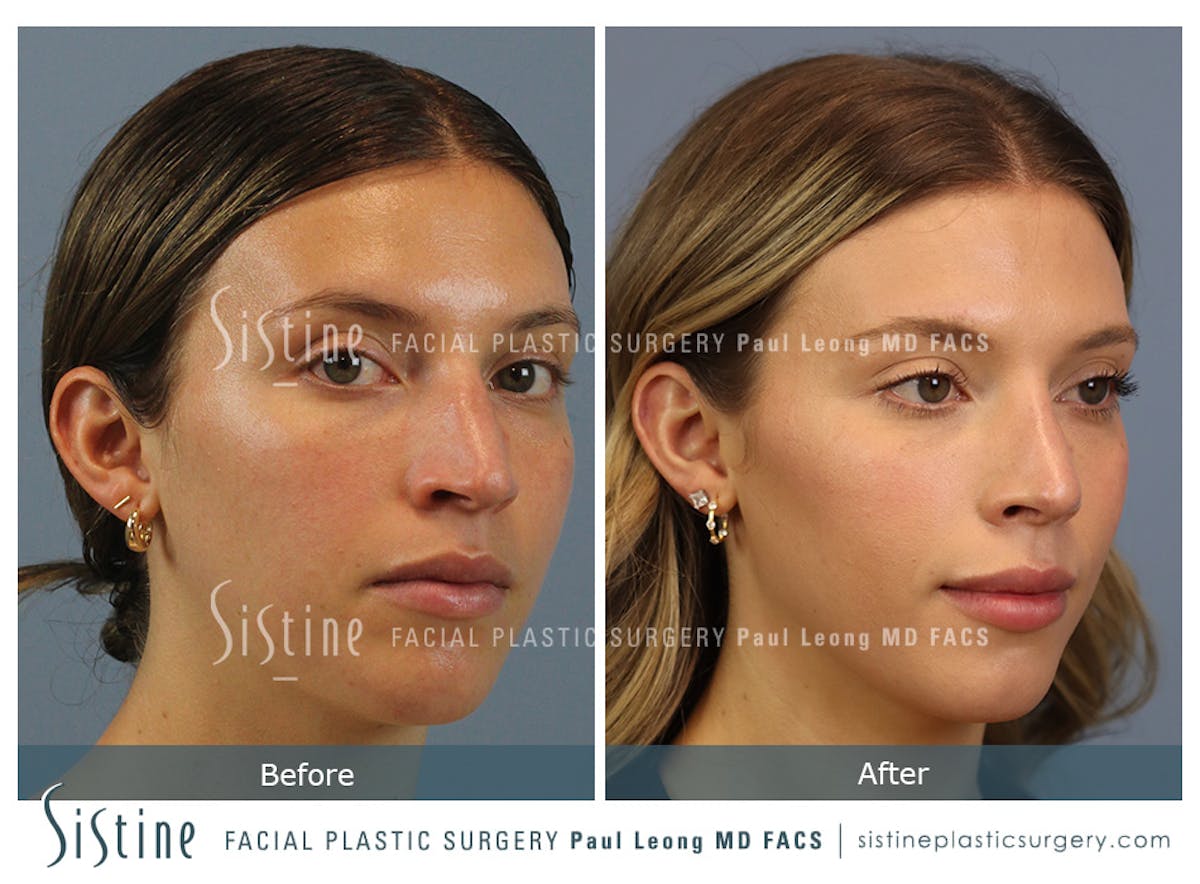 Rhinoplasty Before & After Gallery - Patient 238532 - Image 3