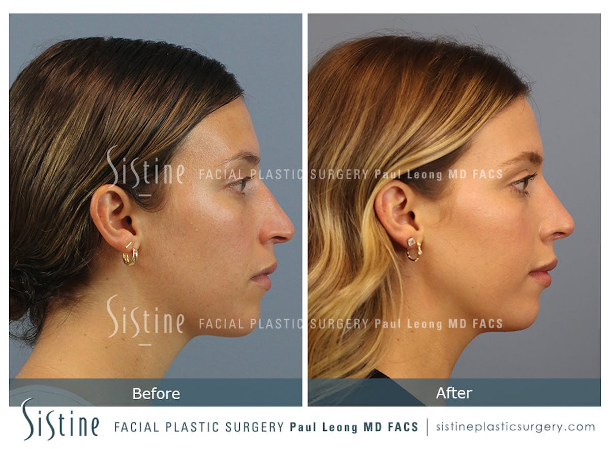 Rhinoplasty Before & After Gallery - Patient 238532 - Image 4