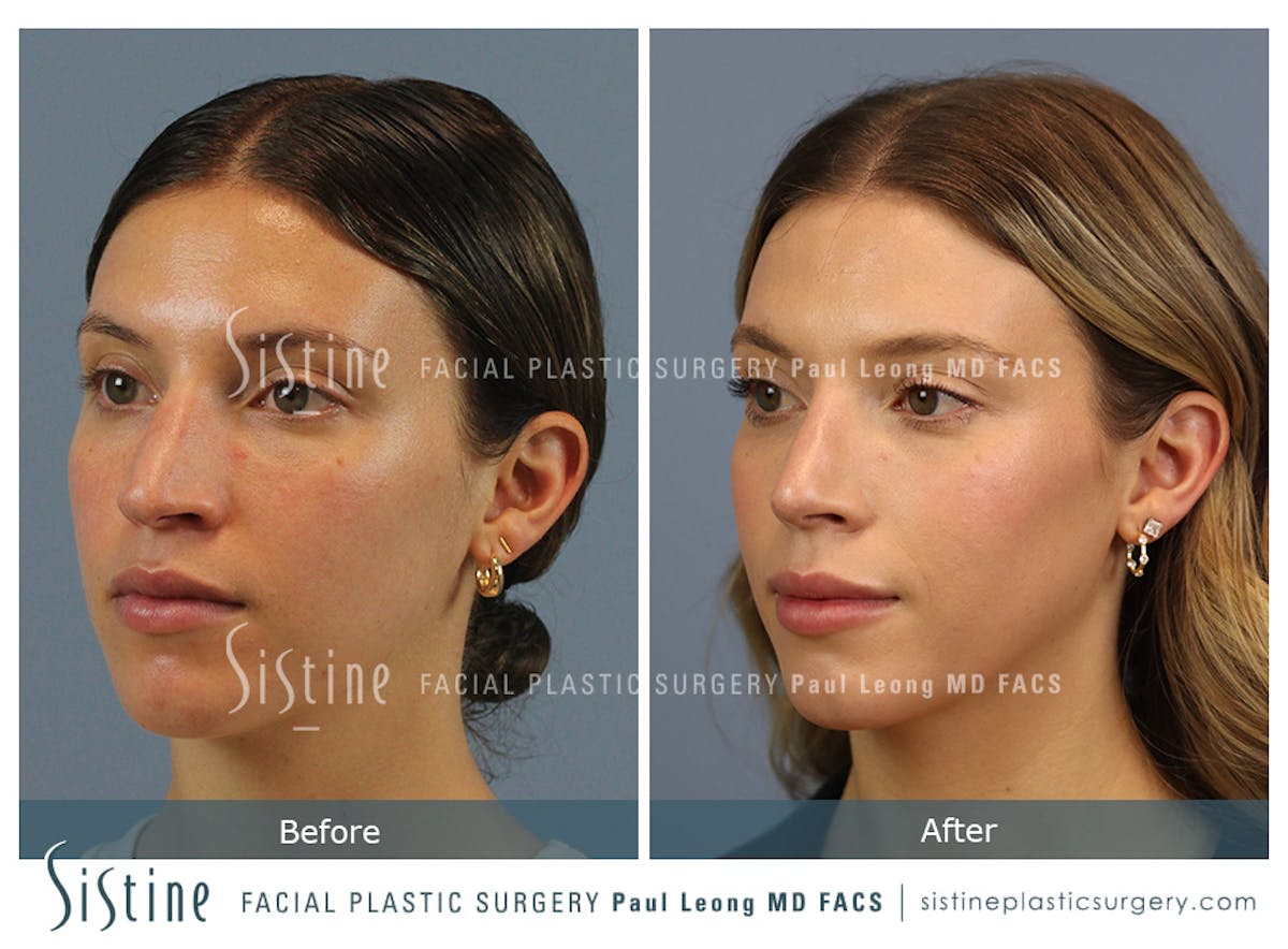Rhinoplasty Before & After Gallery - Patient 238532 - Image 6