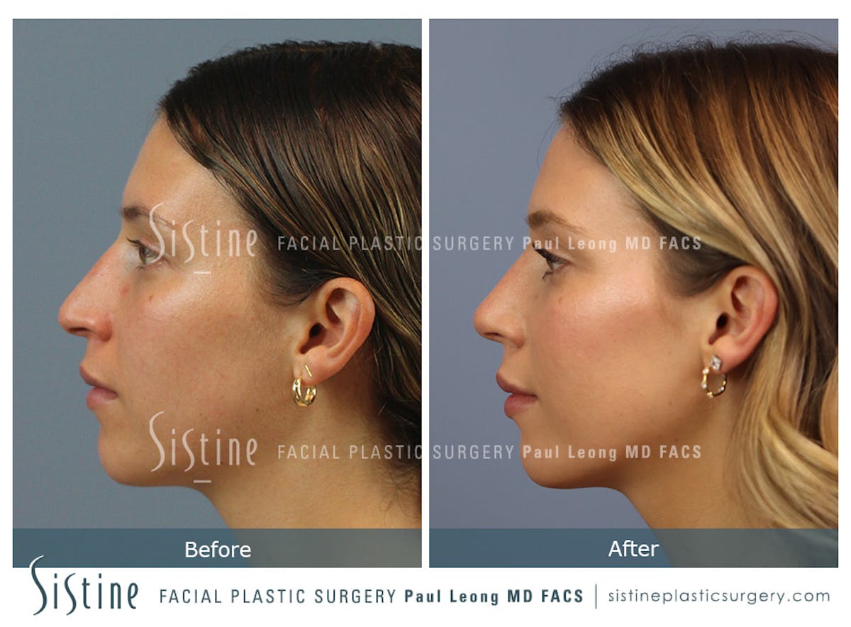 Rhinoplasty Before & After Gallery - Patient 238532 - Image 7