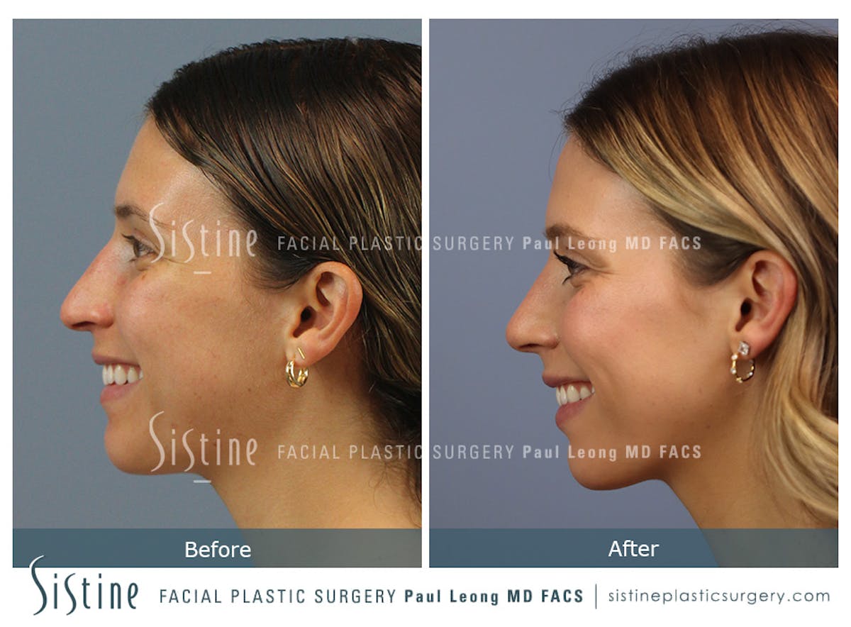 Rhinoplasty Before & After Gallery - Patient 238532 - Image 8