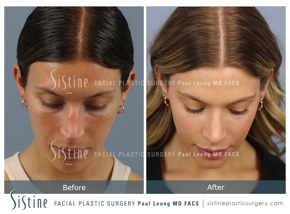 Rhinoplasty Before & After Gallery - Patient 238532 - Image 9