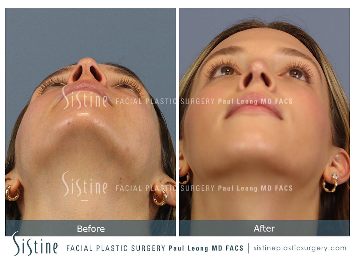 Rhinoplasty Before & After Gallery - Patient 238532 - Image 10