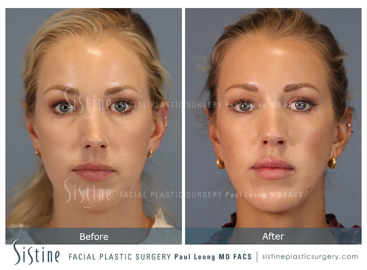 Rhinoplasty Before & After Gallery - Patient 190582 - Image 1