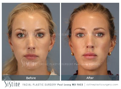 Rhinoplasty Before & After Gallery - Patient 190582 - Image 1