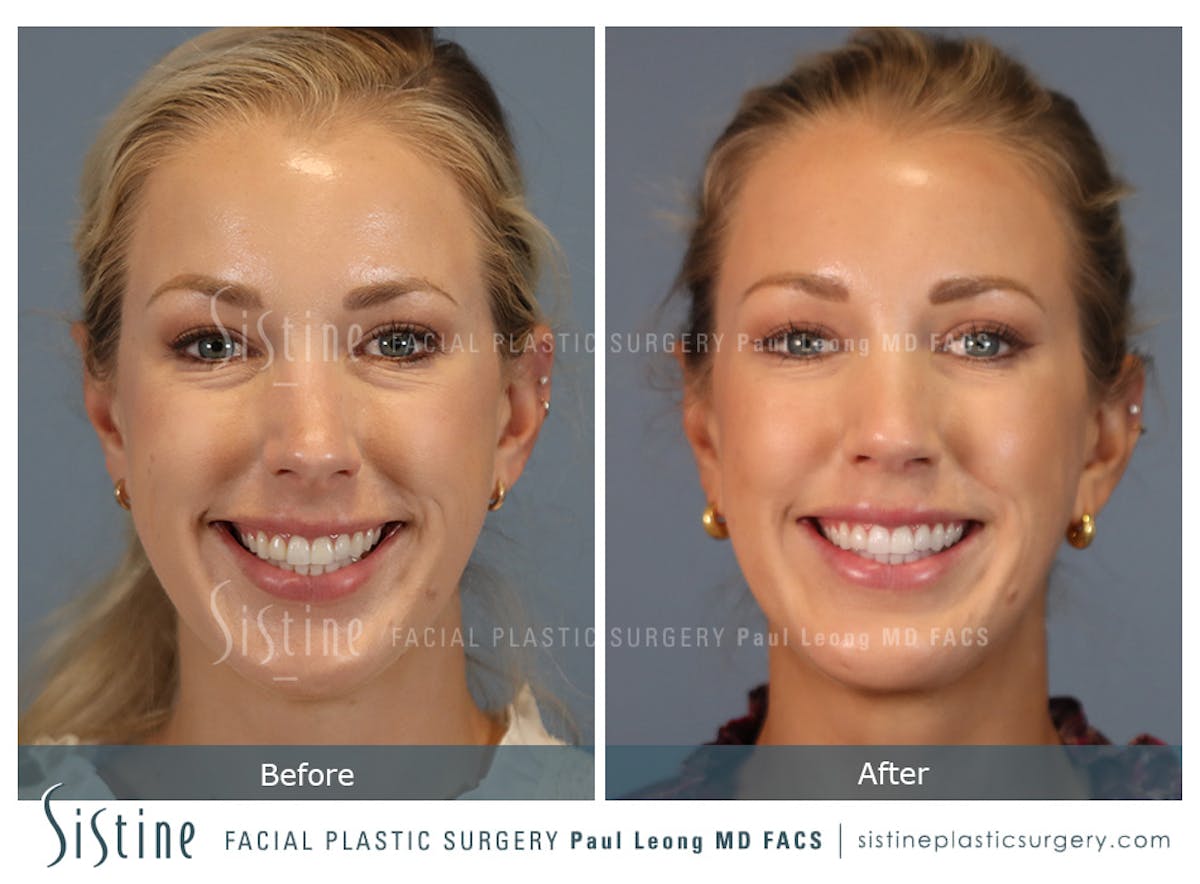 Rhinoplasty Before & After Gallery - Patient 190582 - Image 2
