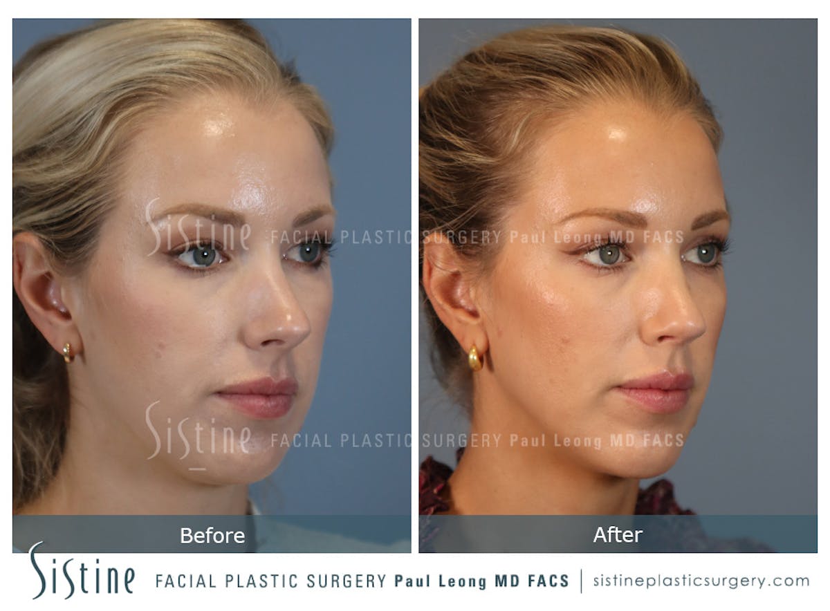 Rhinoplasty Before & After Gallery - Patient 190582 - Image 3