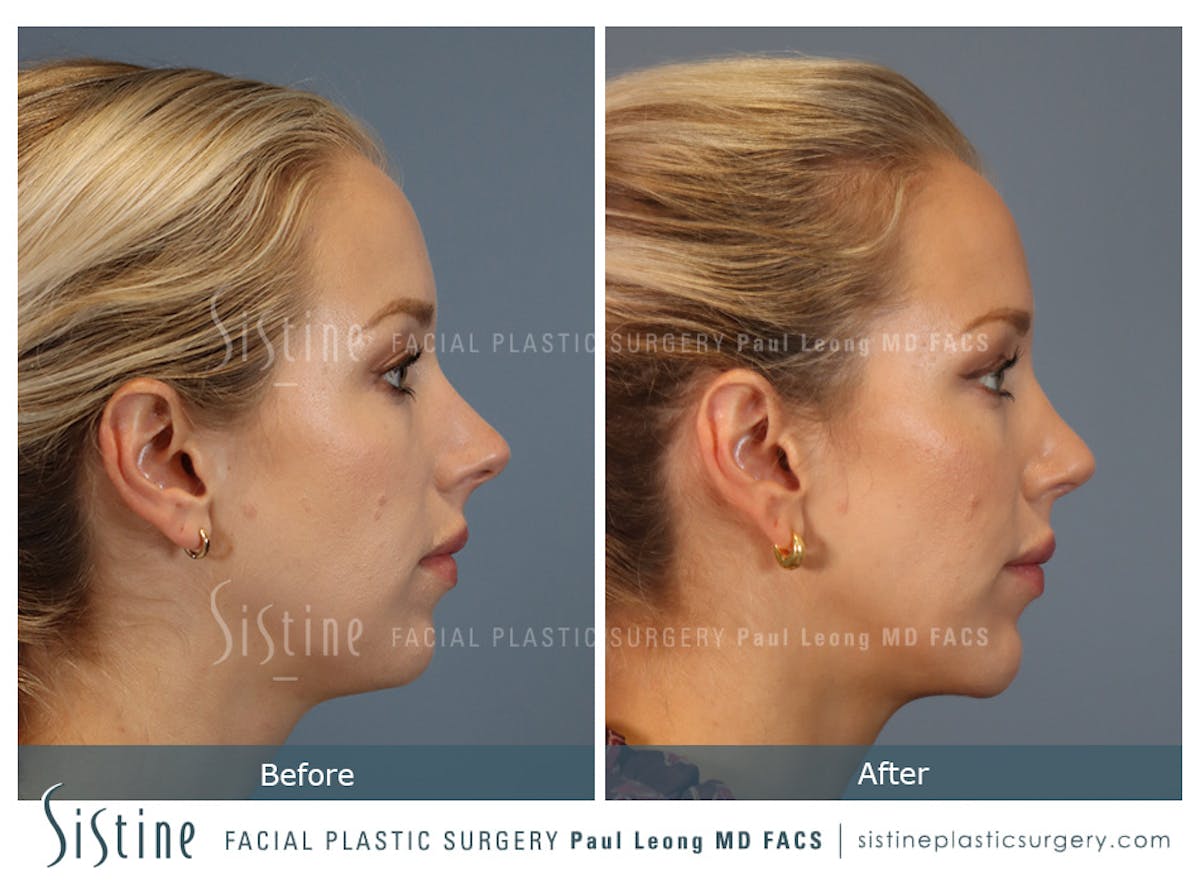 Rhinoplasty Before & After Gallery - Patient 190582 - Image 4