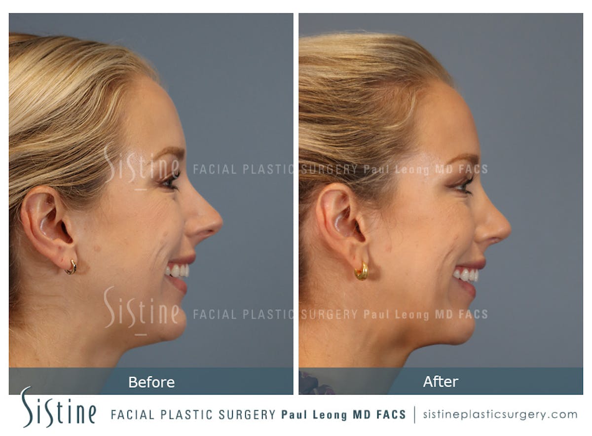 Rhinoplasty Before & After Gallery - Patient 190582 - Image 5