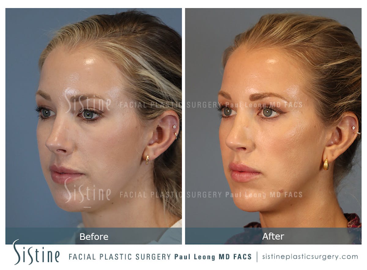 Rhinoplasty Before & After Gallery - Patient 190582 - Image 6