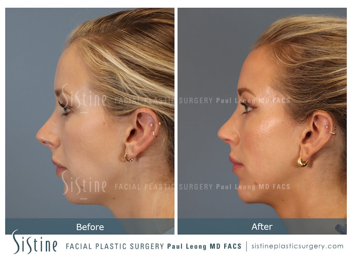 Rhinoplasty Before & After Gallery - Patient 190582 - Image 7