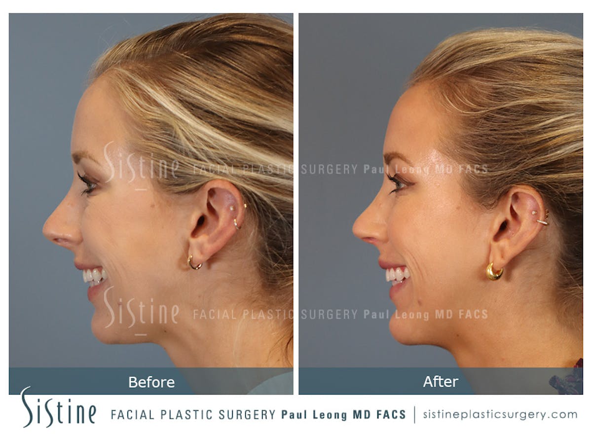 Rhinoplasty Before & After Gallery - Patient 190582 - Image 8