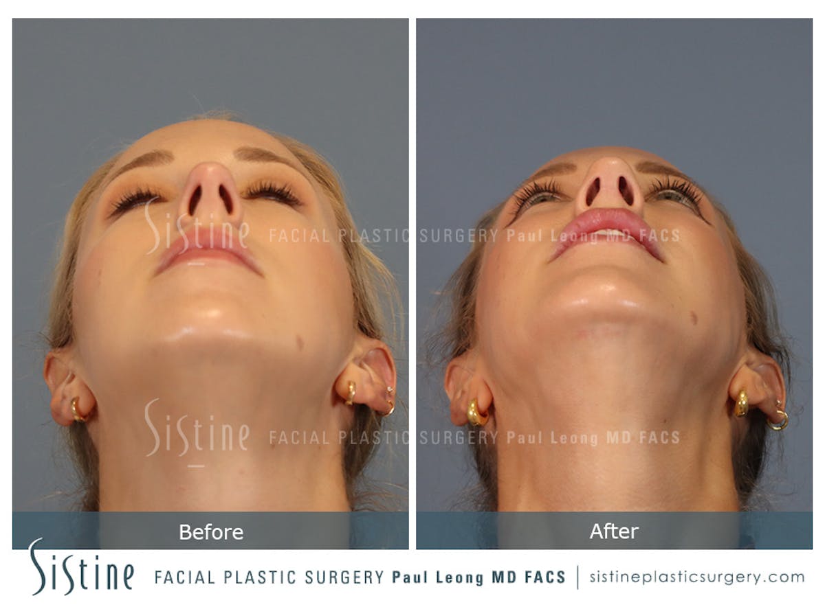 Rhinoplasty Before & After Gallery - Patient 190582 - Image 9