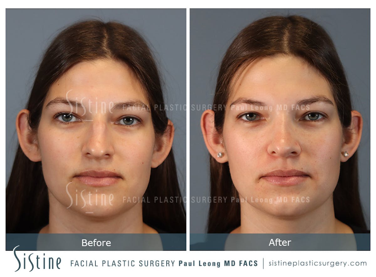 Rhinoplasty Before & After Gallery - Patient 235922 - Image 1