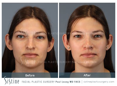Rhinoplasty Before & After Gallery - Patient 235922 - Image 1