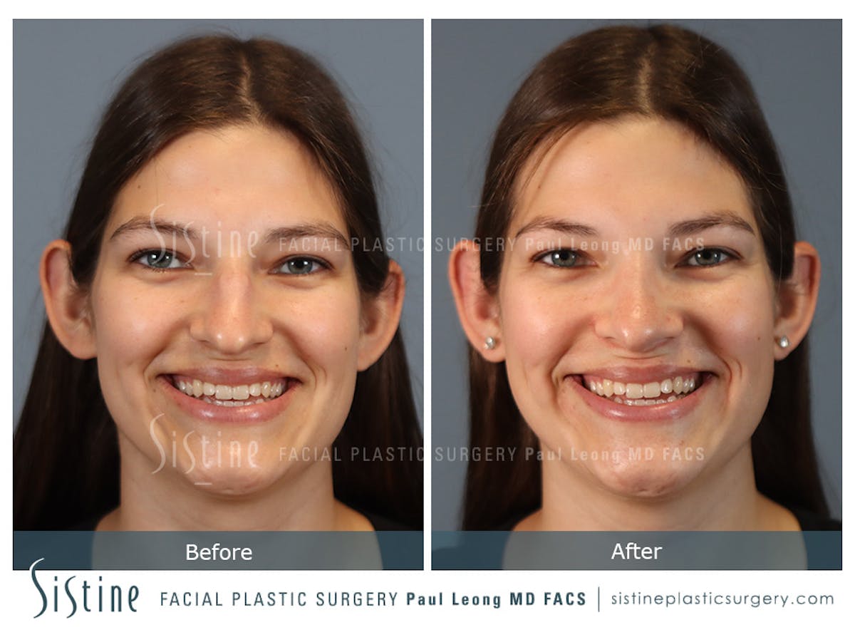 Rhinoplasty Before & After Gallery - Patient 235922 - Image 2