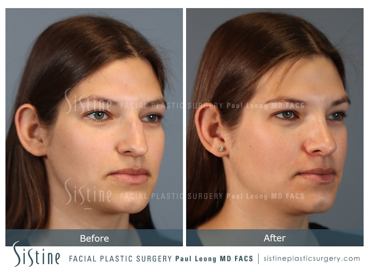 Rhinoplasty Before & After Gallery - Patient 235922 - Image 3