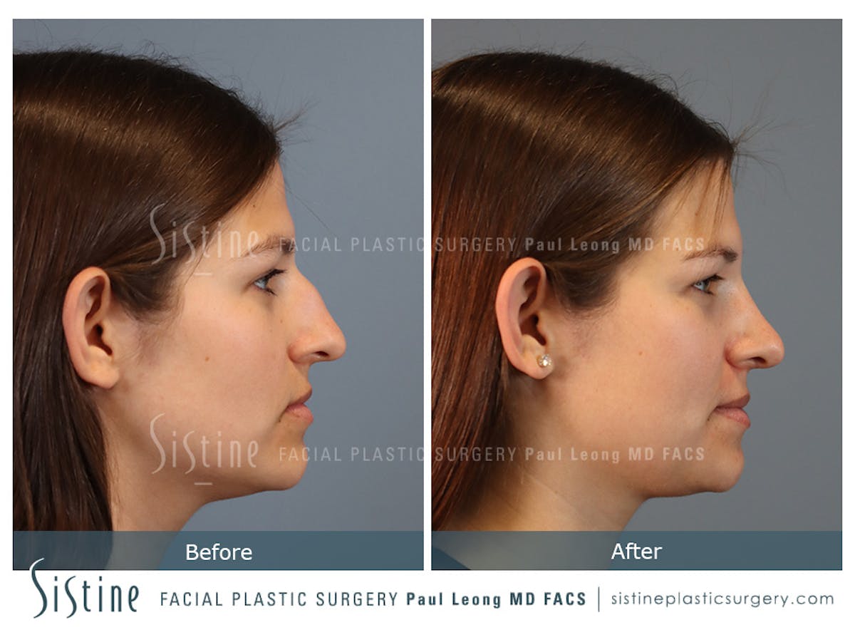 Rhinoplasty Before & After Gallery - Patient 235922 - Image 4