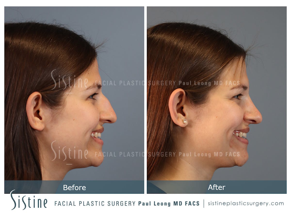 Rhinoplasty Before & After Gallery - Patient 235922 - Image 5