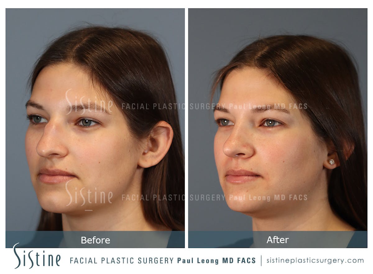 Rhinoplasty Before & After Gallery - Patient 235922 - Image 6