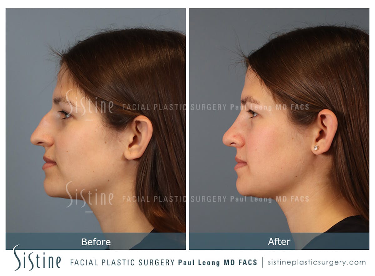 Rhinoplasty Before & After Gallery - Patient 235922 - Image 7