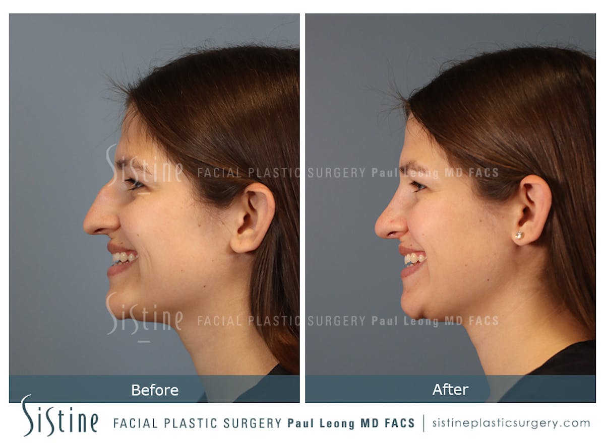 Rhinoplasty Before & After Gallery - Patient 235922 - Image 8