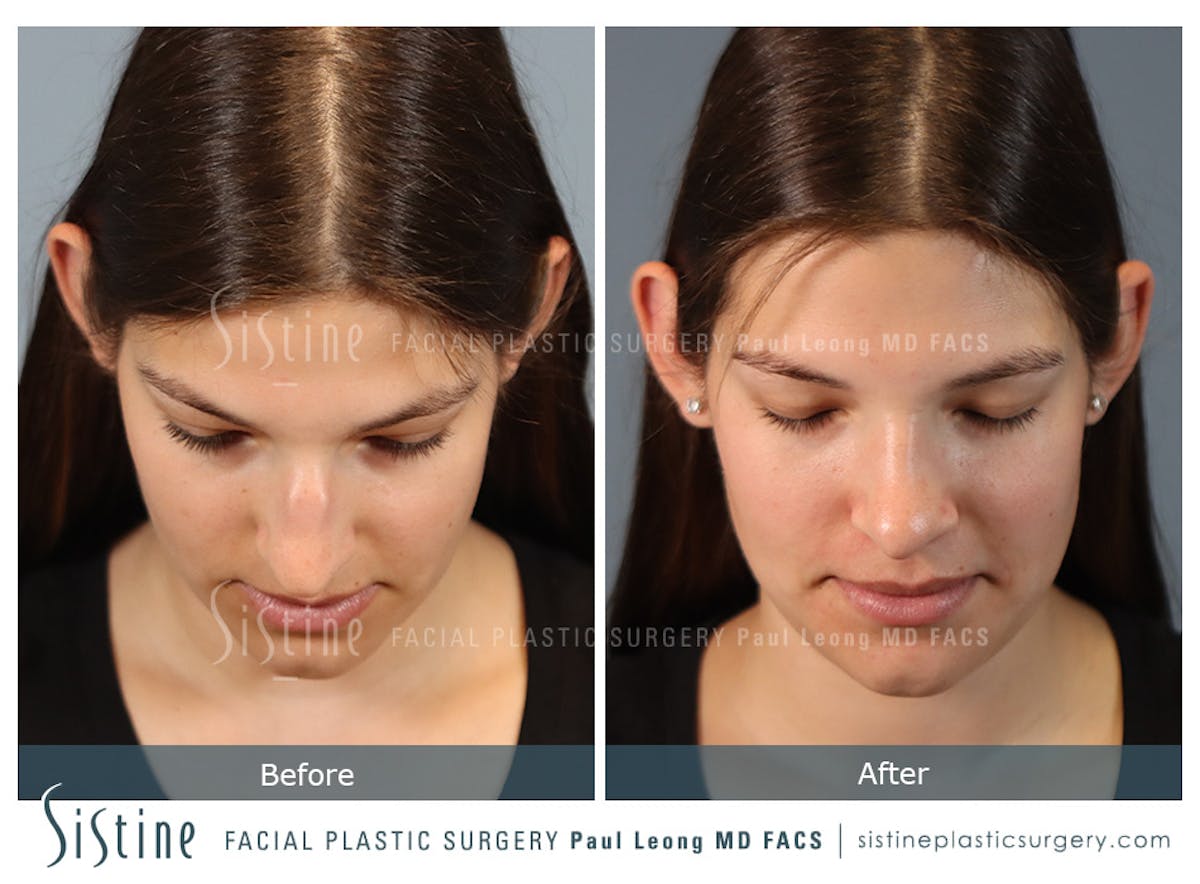 Rhinoplasty Before & After Gallery - Patient 235922 - Image 9