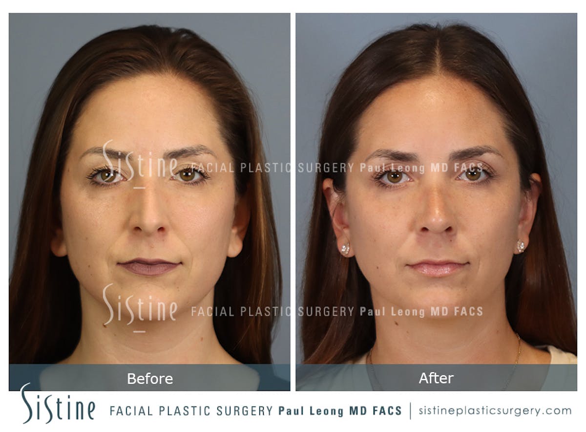Rhinoplasty Before & After Gallery - Patient 244840 - Image 1