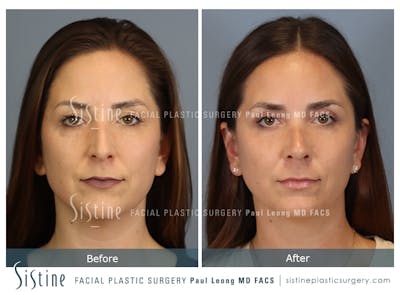 Rhinoplasty Before & After Gallery - Patient 244840 - Image 1