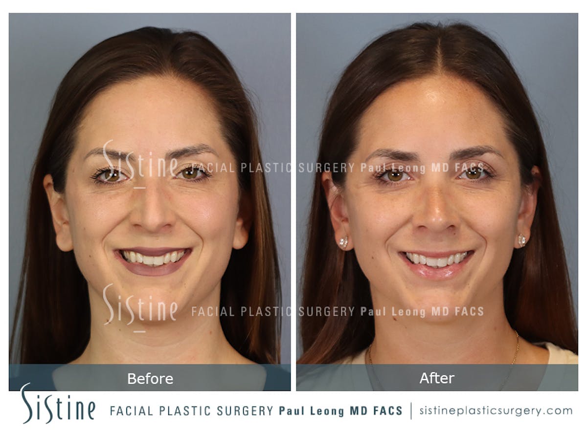 Rhinoplasty Before & After Gallery - Patient 244840 - Image 2