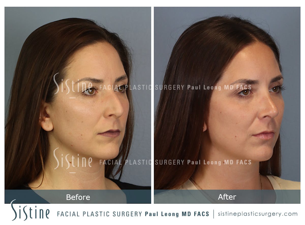 Rhinoplasty Before & After Gallery - Patient 244840 - Image 3