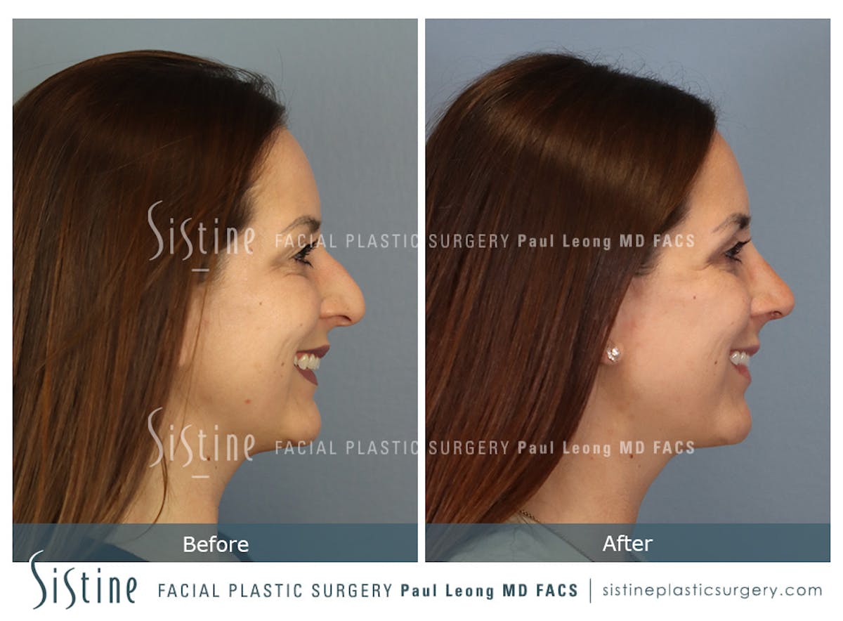 Rhinoplasty Before & After Gallery - Patient 244840 - Image 5