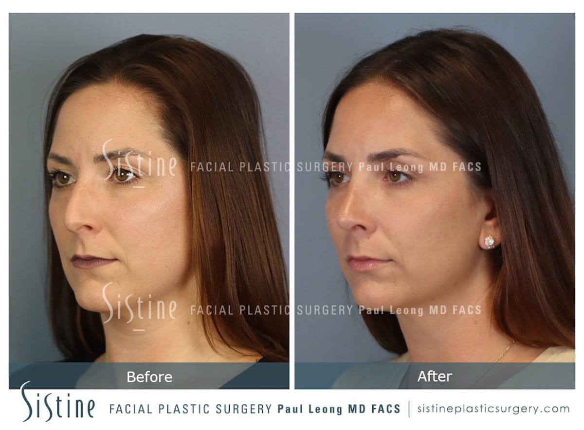Rhinoplasty Before & After Gallery - Patient 244840 - Image 6