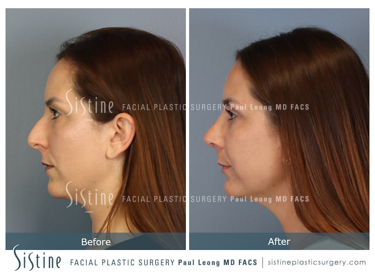 Rhinoplasty Before & After Gallery - Patient 244840 - Image 7