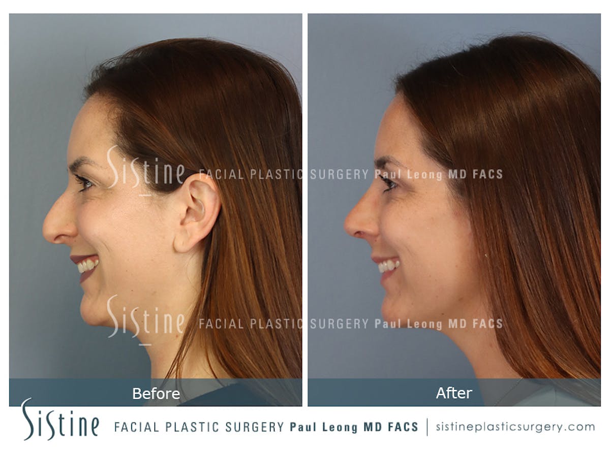 Rhinoplasty Before & After Gallery - Patient 244840 - Image 8