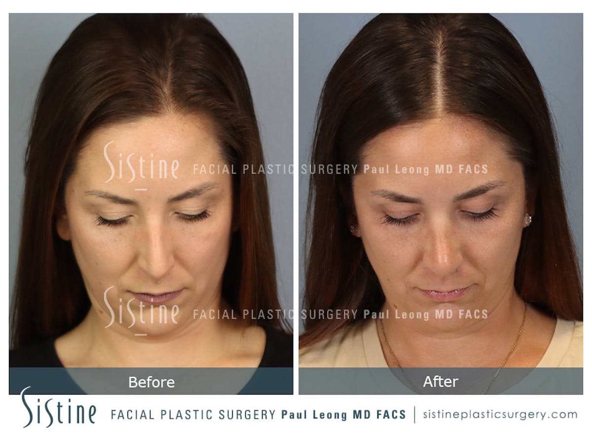 Rhinoplasty Before & After Gallery - Patient 244840 - Image 9