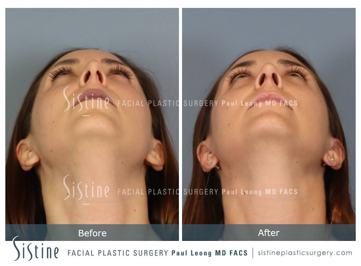 Rhinoplasty Before & After Gallery - Patient 244840 - Image 10