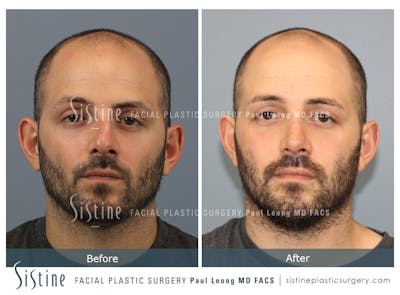 Rhinoplasty Before & After Gallery - Patient 101021 - Image 1