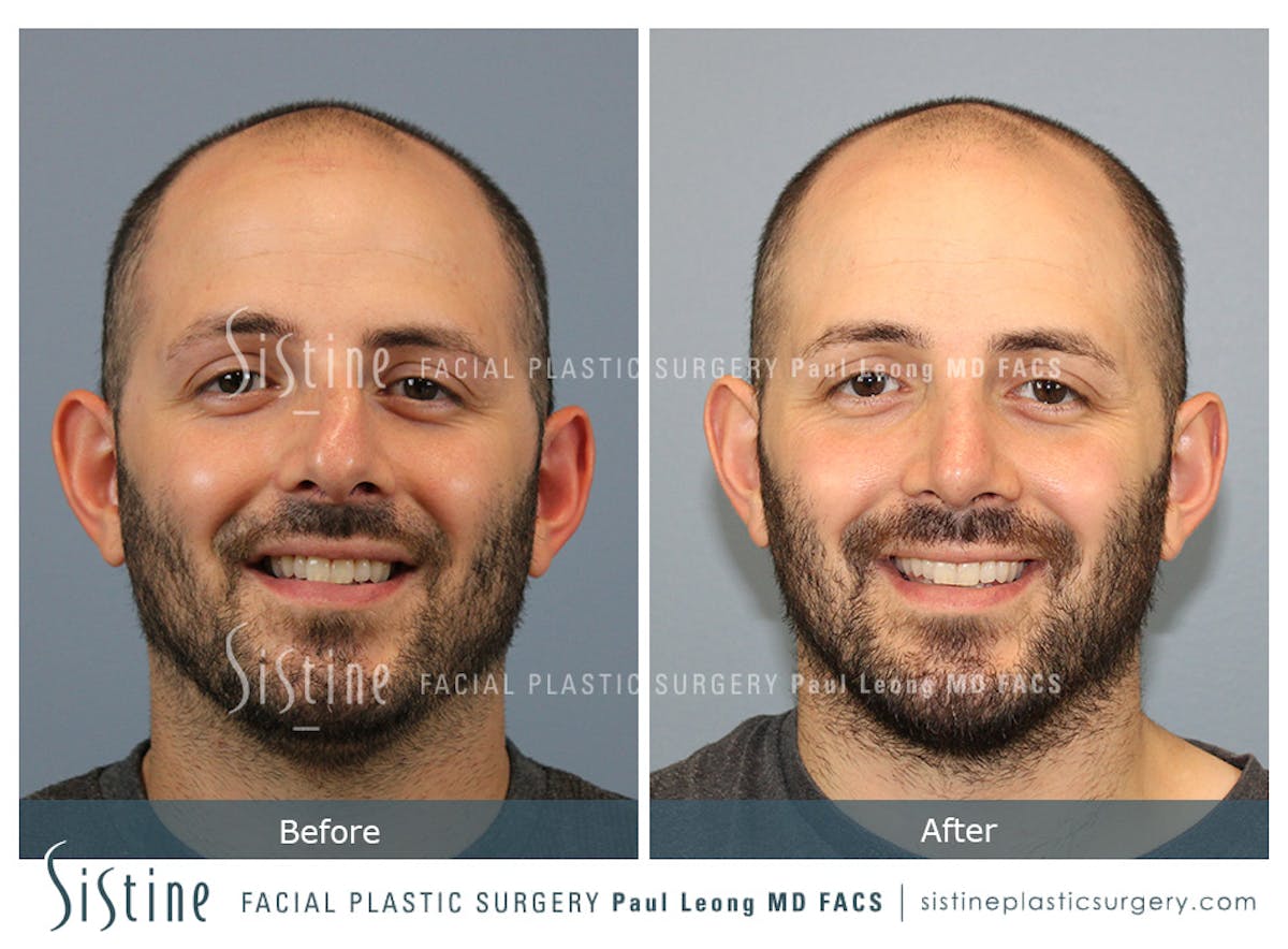 Rhinoplasty Before & After Gallery - Patient 101021 - Image 2