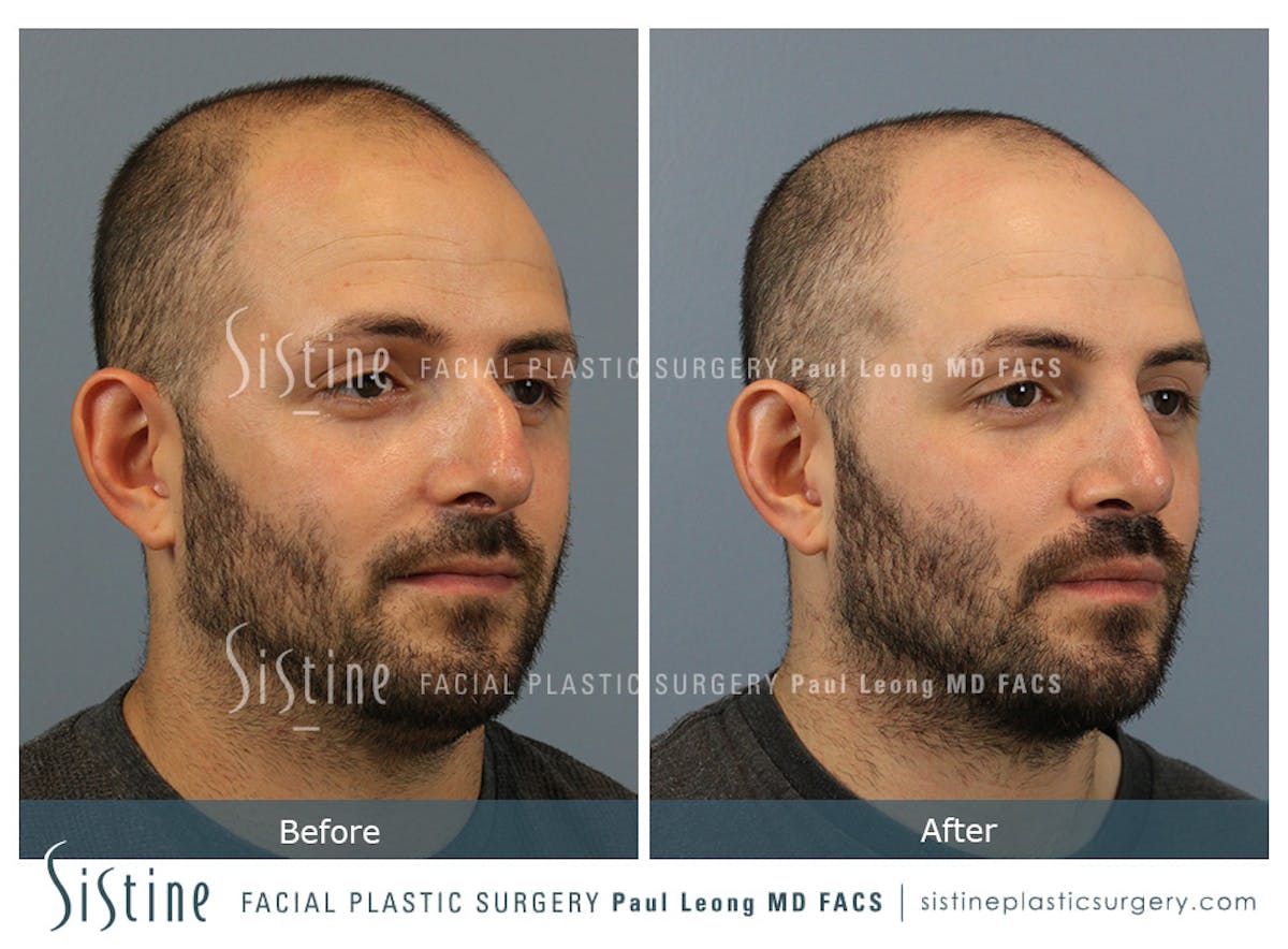 Rhinoplasty Before & After Gallery - Patient 101021 - Image 3