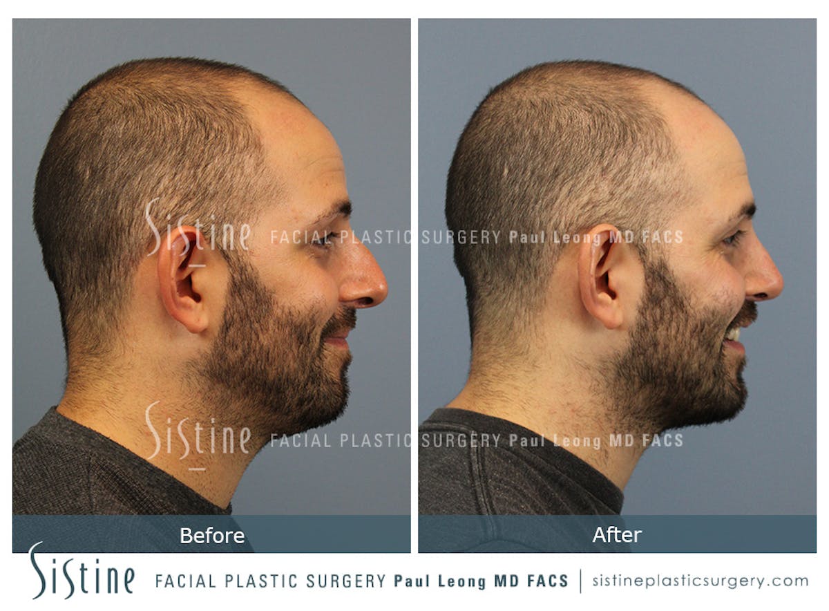 Rhinoplasty Before & After Gallery - Patient 101021 - Image 4
