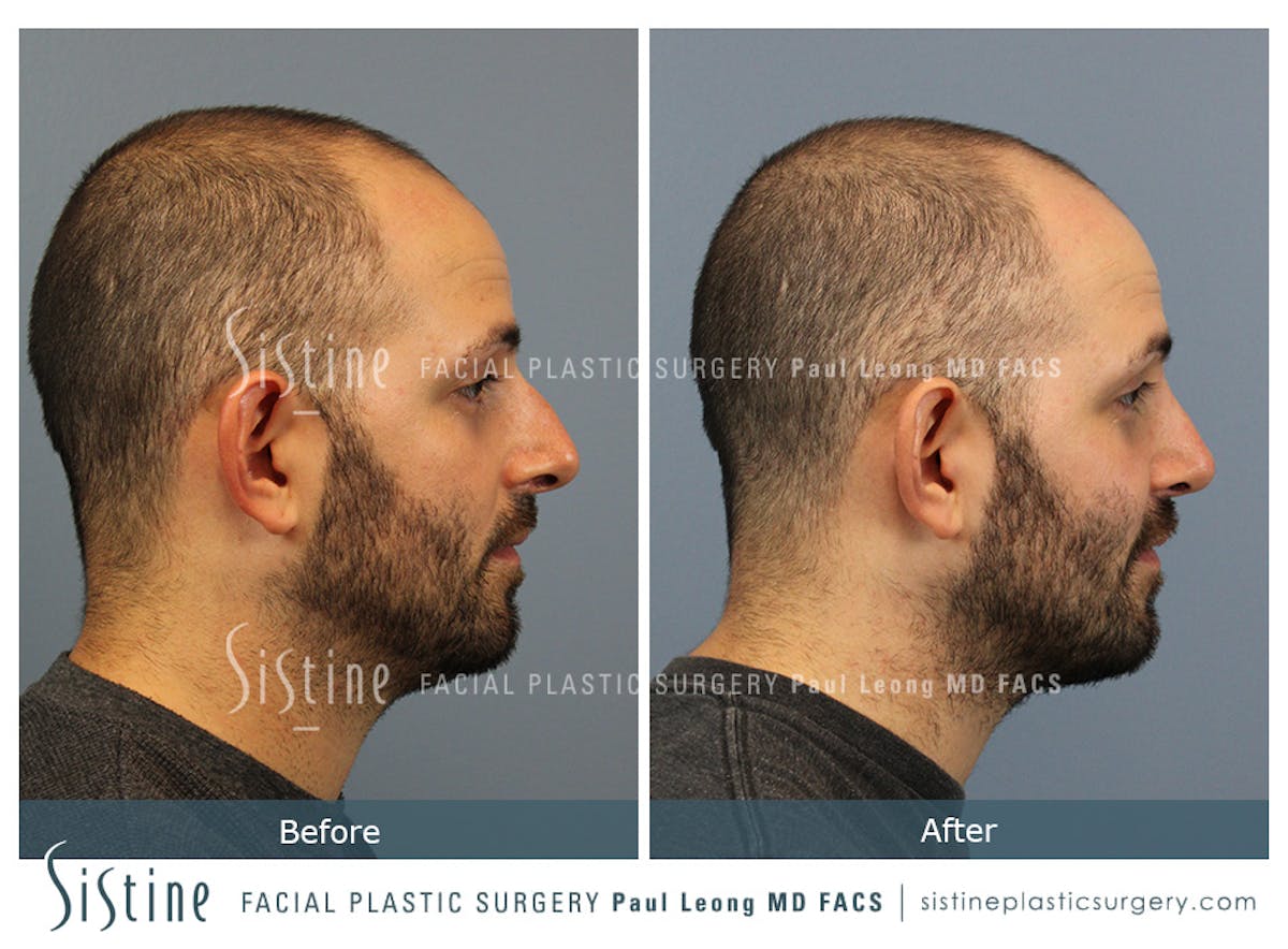 Rhinoplasty Before & After Gallery - Patient 101021 - Image 5