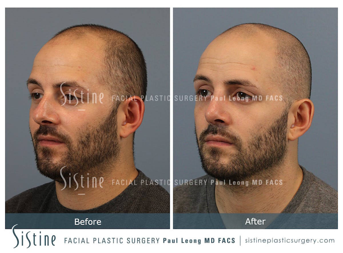 Rhinoplasty Before & After Gallery - Patient 101021 - Image 6