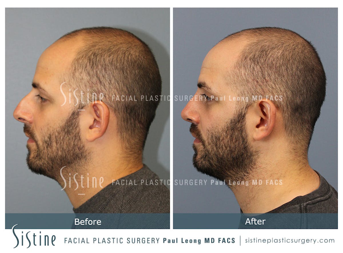 Rhinoplasty Before & After Gallery - Patient 101021 - Image 7