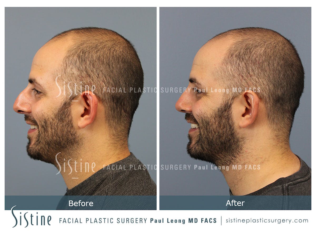 Rhinoplasty Before & After Gallery - Patient 101021 - Image 8