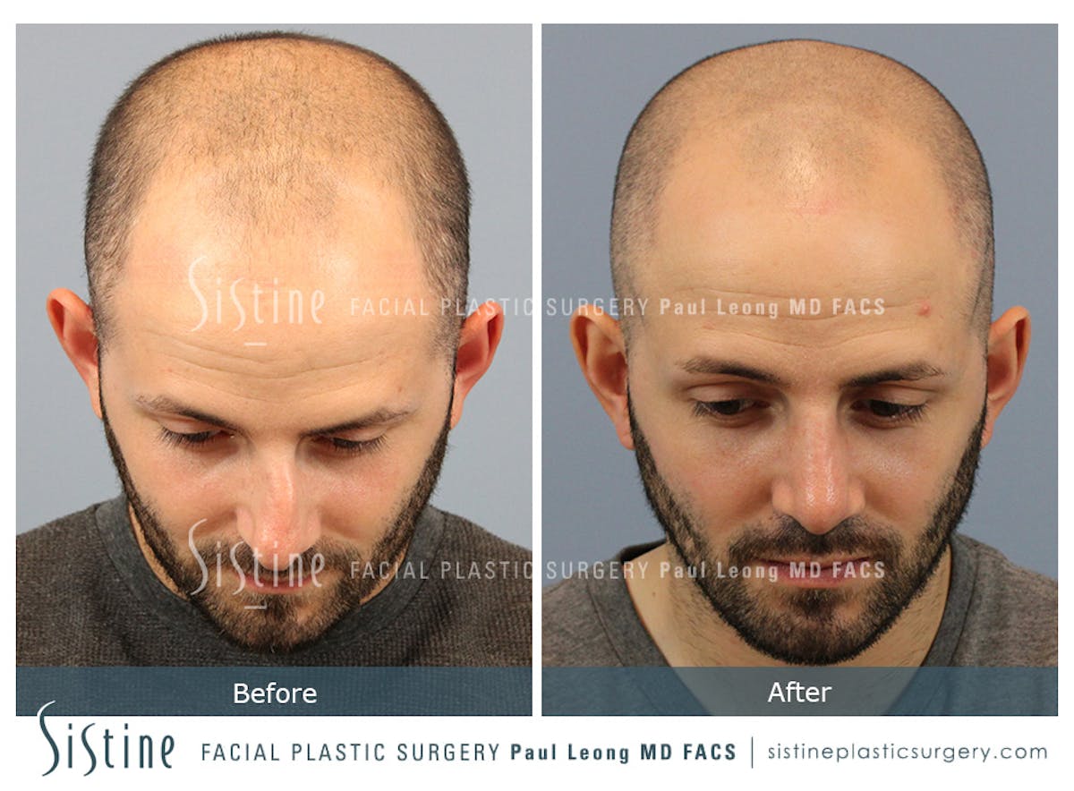 Rhinoplasty Before & After Gallery - Patient 101021 - Image 9